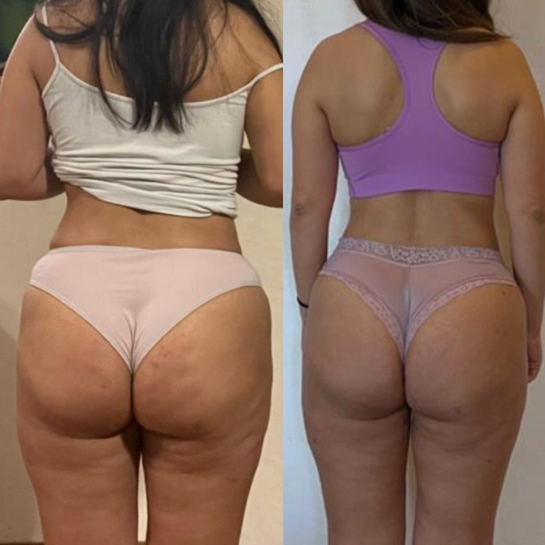 REDUCE CELLULITE IN 8 WEEKS (5 SPOTS LEFT) - SWEATNGLOW