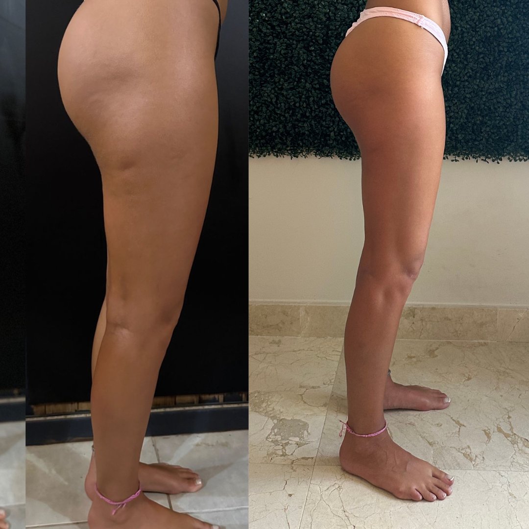 REDUCE CELLULITE IN 8 WEEKS (5 SPOTS LEFT) - SWEATNGLOW